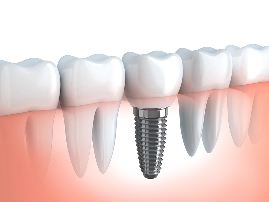 インプラント治療